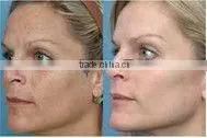 nd yag laser hair removal long pulse laser Skin Rejuvenation equipment