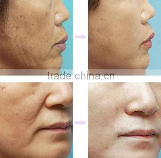 ce approve vertical ipl hair removal machine with 3 filters A006