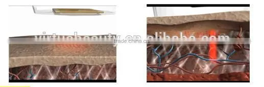 Virtue beauty facelift RF Fractional Thermal Machine