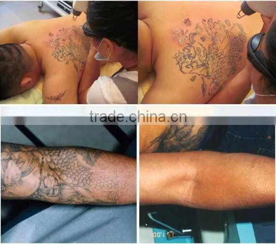 Newest design beauty equipment Q-switched ND YAG laser eyeliner washing tattoo removal laser