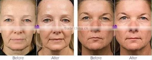fractional rf microneedle for wrinkle removal fractional rf microneedle face treatment