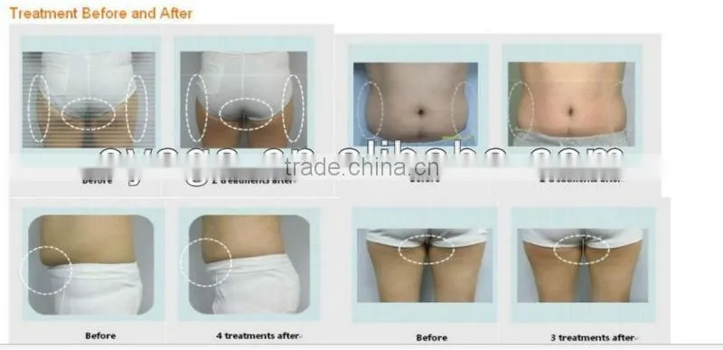 Cavitation RF weight loss beauty shop equipment