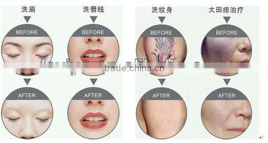 VY-C70 NEW PRO Q SWITCH YAG LASER MACHINE TATTOO EYEBROW REMOVAL