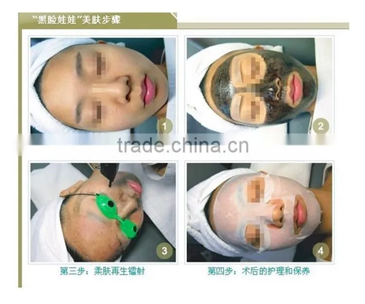 Freckle removal laser nd yag q-switched
