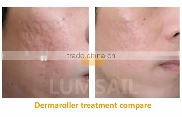 540needles Dermaroller /Derma Skin Roller /Microneedles Dermaroller