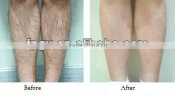 2013 high-power ND Qswitced Yag Laser E-light and RF 3 in 1 hair removal Machine