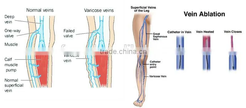 30W and effective vascular removal diode laser 980