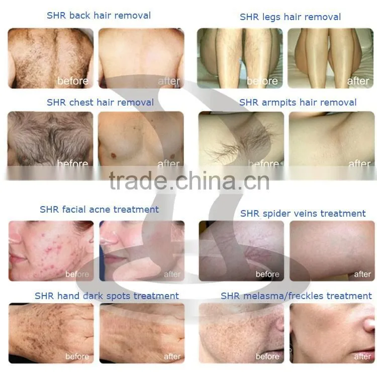 Effective !!! Hair removal a portable elight (IPL+RF) +SHR+OPTfor wrinkle and pigment removal with high quality