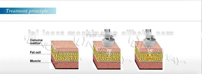 vacuum liposuction,liposuction ultrasonic,new non invasive liposuction