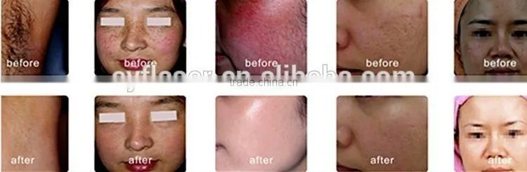 808nm diode laser permanent hair removal system/808nm diode laser