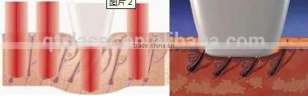 808nm diode laser portable hair removal beauty equipment portable with CE