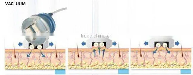 Vacuum Cavitation Ultrasonic Cavitation Slimming Machine