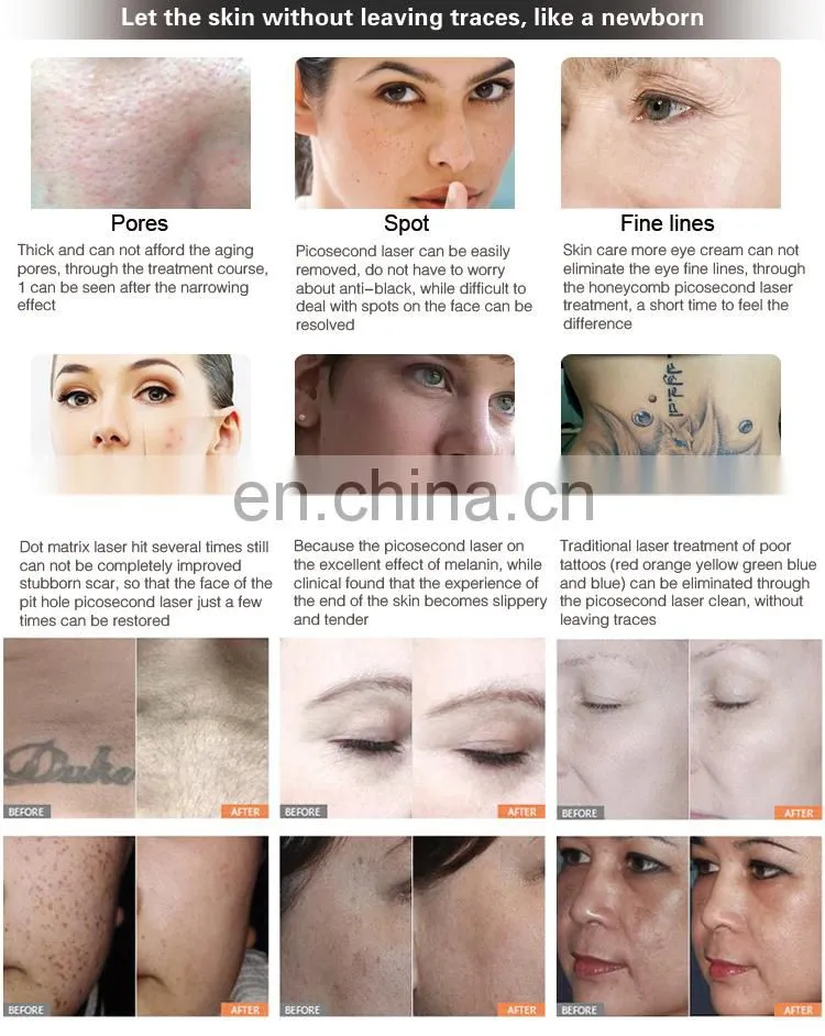 skin lightening 755 laser picosur pigment remover machines picosecond laser pigmentation removal