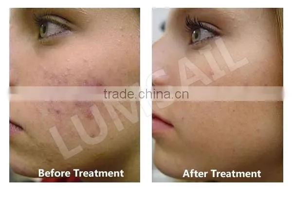 LED Phototherapy Lamp/Beauty Salon Infrared Lamp/Facial skin acne/skin tightening/skin rejuvenation/hair loss treatments