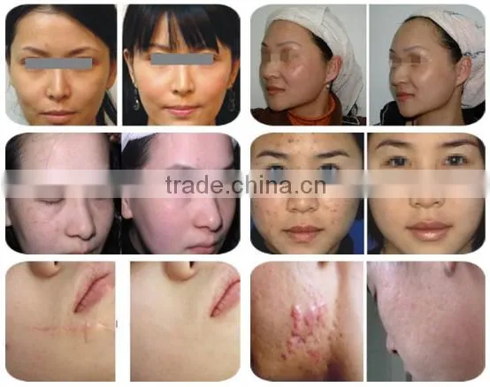 rf co2 fractional laser equipment / rf driver fractional co2 laser / vaginal tightening laser