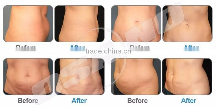 Perfect fast slimming cryotherapy equipment