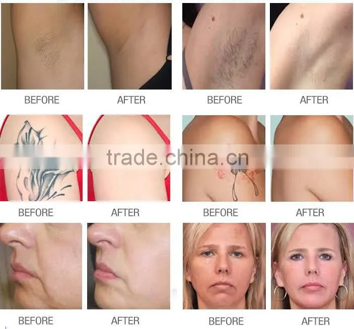 LINGMEI SHR laser IPL hair removal/ fast hair removal