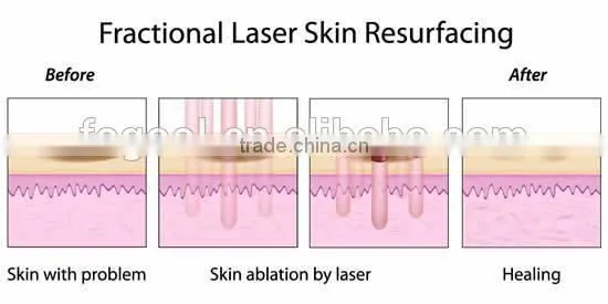 Professional Co2 Fractional Laser Promotion Price Co2 Skin Resurfacing Medical Professional Co2