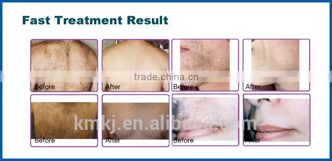 Professional 808nm diode laser handpiece imported from Germany (CE/ISO/TUV/ROHS)
