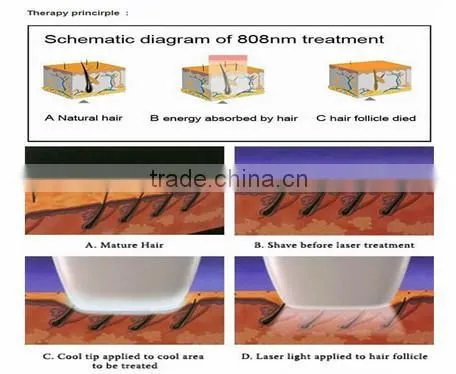 hot newest Germany 808nm diodes laser hair removal product