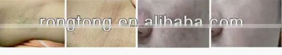 Portable IPL hair removal Medical CE Approved Med-100