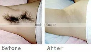 hot sale 100% effective hair remover machine 808nm diode laser for hair removal