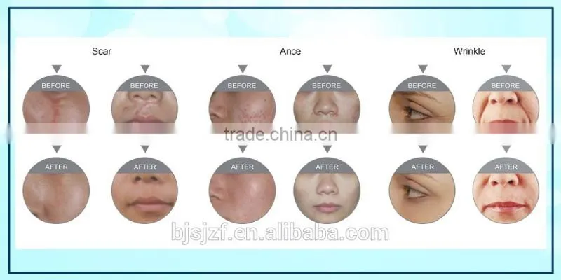 F5 Portable Style Fractional home laser scar removal fractional co2 laser