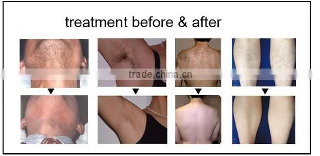 professional ipl hair removal machine/wrinkle removal beauty machine