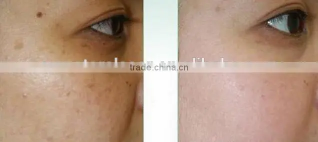 co2 fractional laser machine , co2 laser power supply/ Machines of fractional co2 laser