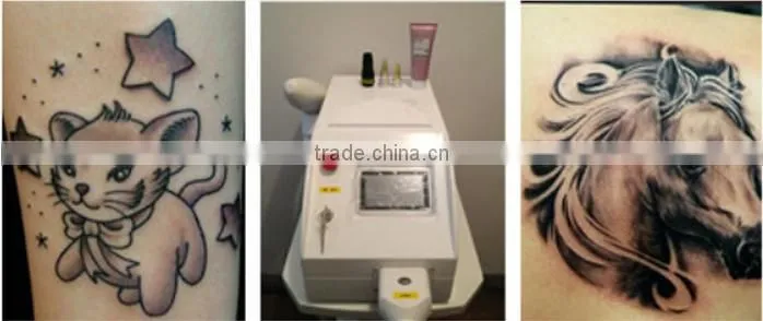 Sanhe ce 2 years warranty q switch nd yag laser tattoo removal medical laser nd yag equipment