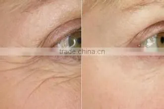 fractional rf microneedle scarlet device/microneedle thermagic rf fractional machine