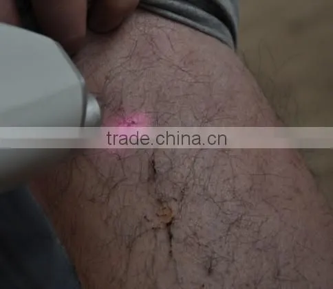 (ISO13485/CE Proof) NEWEST 808nm hair laser removal machine with freon cooling OB-DH 03