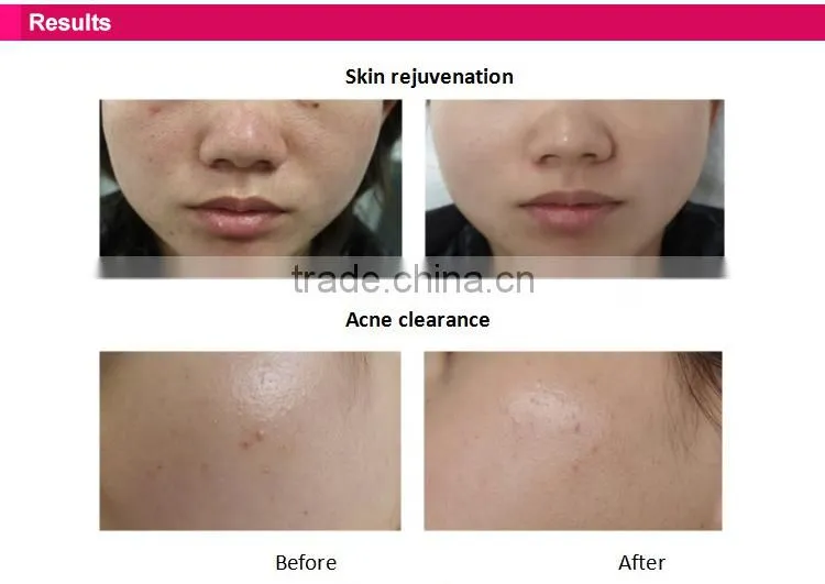 Best selling products portable IPL beauty machine for home use/ipl hair removal