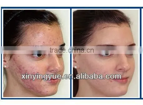 Newest Protable SHR 2 handles Hair Removal OPT IPL RF Facial Whitening