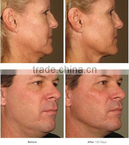 portable no-surgical treatment to tighten sagging skin beauty machine