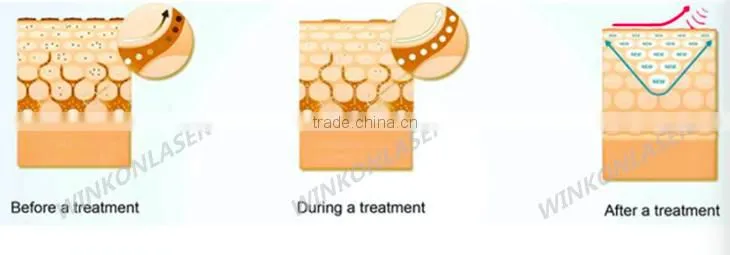 varicose veins / blood vessel spider vein treatment / spider vein spot removal machine