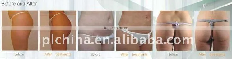 body reshaping ultrasonic cavitation slimming equipment