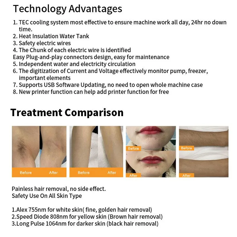 High Power 1800w Germany 808nm Ice Diode Laser Hair Removal 755 808 1064nm Laser Depilation Machine