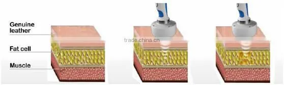 Newest beauty system hifu beauty device