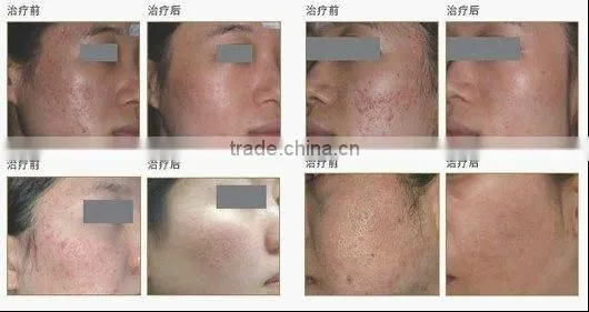 professional fractional co2 laser scar removal
