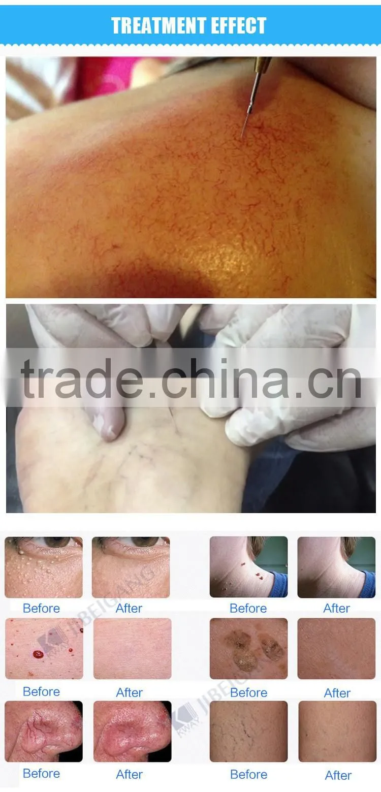 CE approved high frequency 30 MHz RBS laser spider vein removal machine for sale