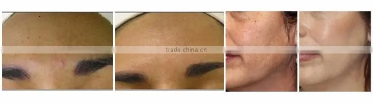 Skin Care professional aqua peel machine diamond dermabrasion equipment