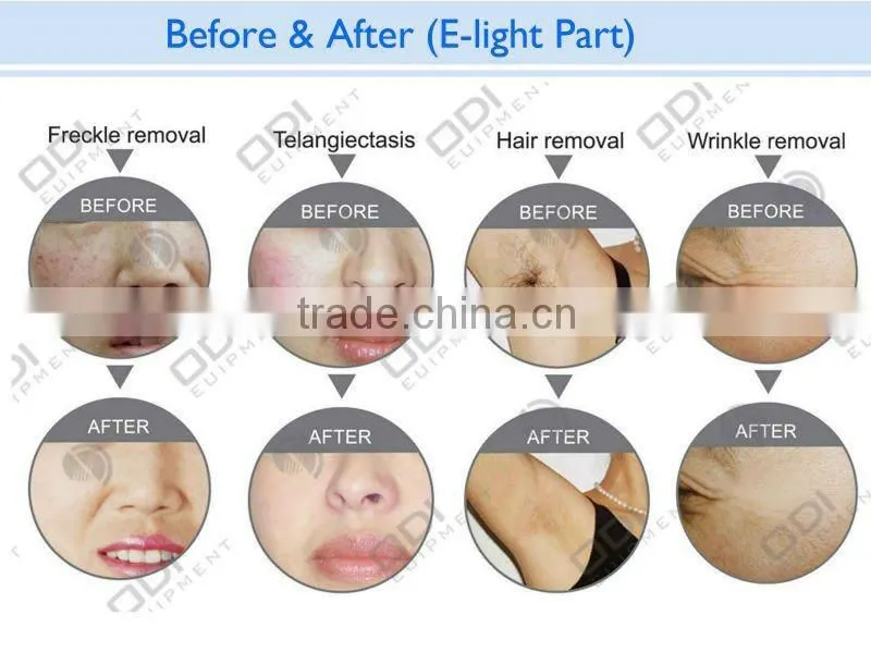 Hot in 2014 !! Tattoo and Hair Removal E light ipl rf nd yag laser (CE-Approve)