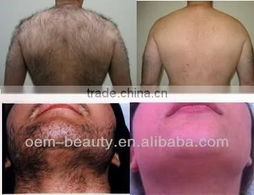 Protable soprano laser hair removal machine P003