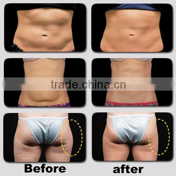 Freezefats System used body slimming machine