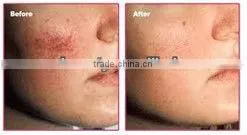the lasest technology yag laser hair removal machine