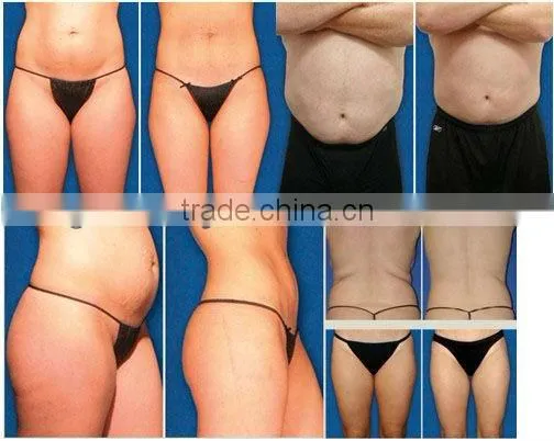 WL-20 ND i lipo laser inch loss machine including 10pads