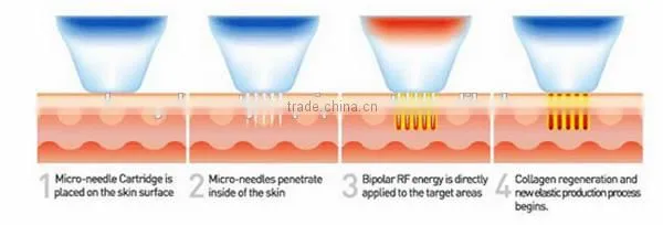 Factory price!!!rf fractional microneedle for Whiten Skin & Restore Skin Elasticity