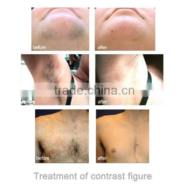 multi-function hair removal skin rejuvenation tattoo removal nd yag laser rf and elight beauty machine