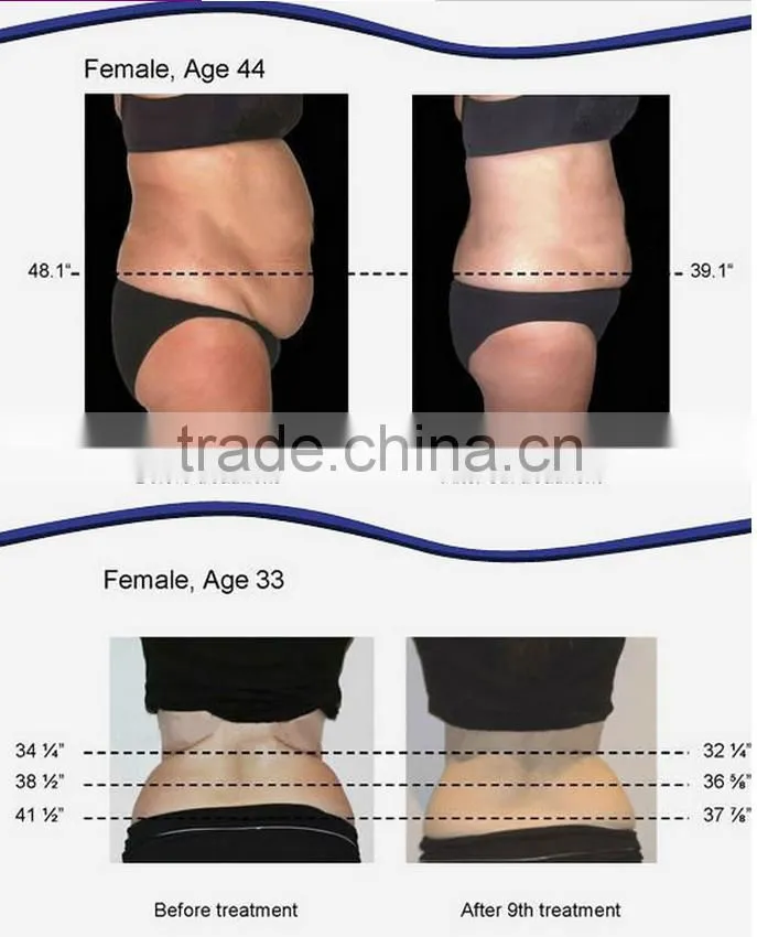 2016 Excellent Results Ultrasonic Cavitation Vacuum RF Slimming Machine